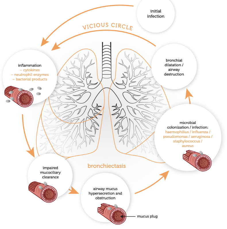 <p><span><span> Persistent airway inflammation → bronchial wall oedema → increased mucus production</span></span></p><p><span><span>→ Inflammatory cells (neutrophils, T cells) recruited to the airways</span></span></p><p><span><span>→ Cytokines, proteases, and R.O.S destroy the airways</span></span></p><p><span><span>Bronchial damage leads to colonisation of the airways</span></span></p><p><span><span>** Cycle of colonisation and subsequent chronic inflammation leads to progressive airway damage and recurrent infection</span></span></p>