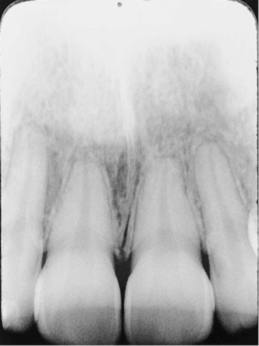 <p>-Teeth appear short with blunted roots</p><p>-Vertical angulation was excessive, or too steep, resulting in images that are shorter than the actual teeth</p><p>-This occurs more often with the bisecting technique</p><p>-To prevent do not use excessive vertical angulation</p>