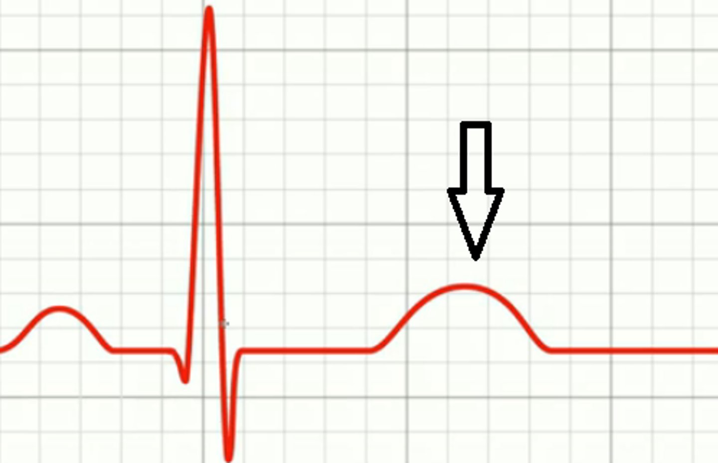 <p>Ventricular repolarization (relaxation)</p>
