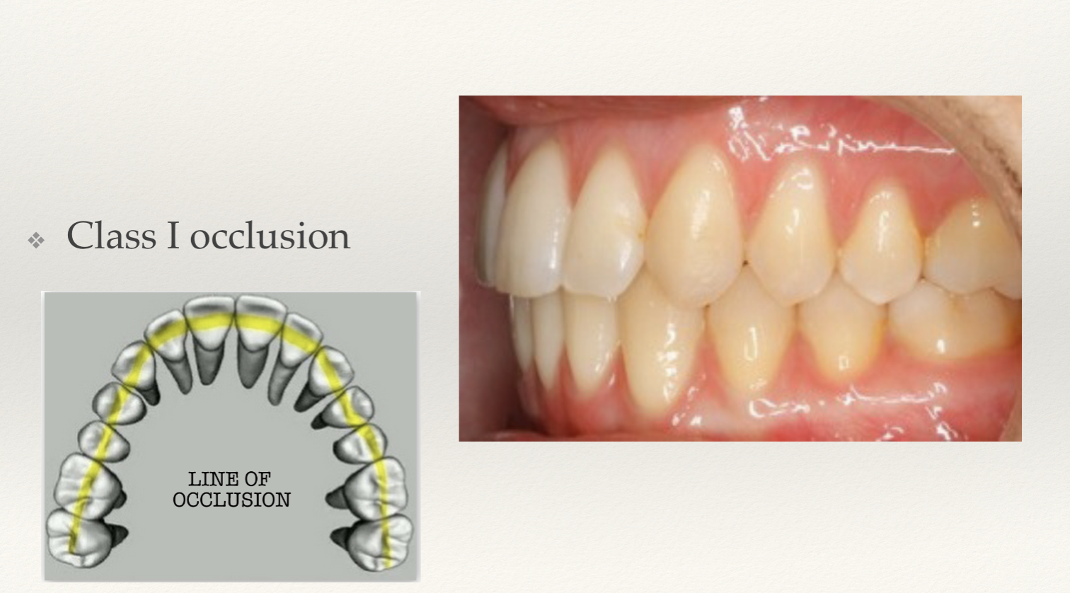 <p>Malocclusion can still be in class 1. <span style="font-size: calc(var(--scale-factor)*22.00px);"><span>❖ </span></span><span style="font-size: calc(var(--scale-factor)*36.00px);"><span>Normal relationship of the molars,</span></span><br><span style="font-size: calc(var(--scale-factor)*22.00px);"><span>❖ </span></span><span style="font-size: calc(var(--scale-factor)*36.00px);"><span>Curve of the arch is incorrect (crowding, tooth rotation, etc).</span></span></p>