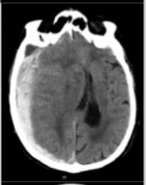 <p>What type of intracranial hemorrhage is characterized by an acceleration-deceleration injury sheering veins and more common in the elderly due to atrophy</p>