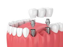 <p>Metal posts (usually titanium) placed in the jawbone to replace tooth roots and support restorations.</p>