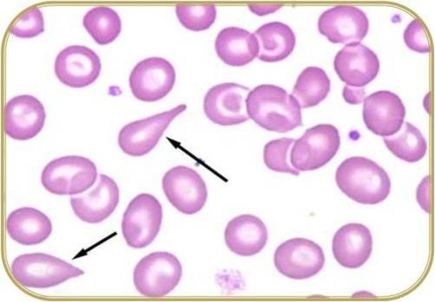 <p>Englarged spleen</p><p>dont cry about your enlarged spleen</p>