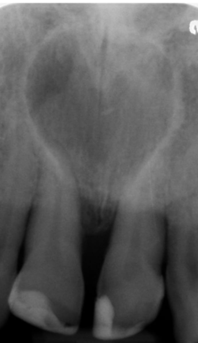 <p>- >6 mm</p><p>-well-circumscribed radiolucency near midline of anterior maxilla</p><p>-round-oval w/ sclerotic border</p><p>-inverted pear or heart shaped</p><p>-+/- root divergence</p>