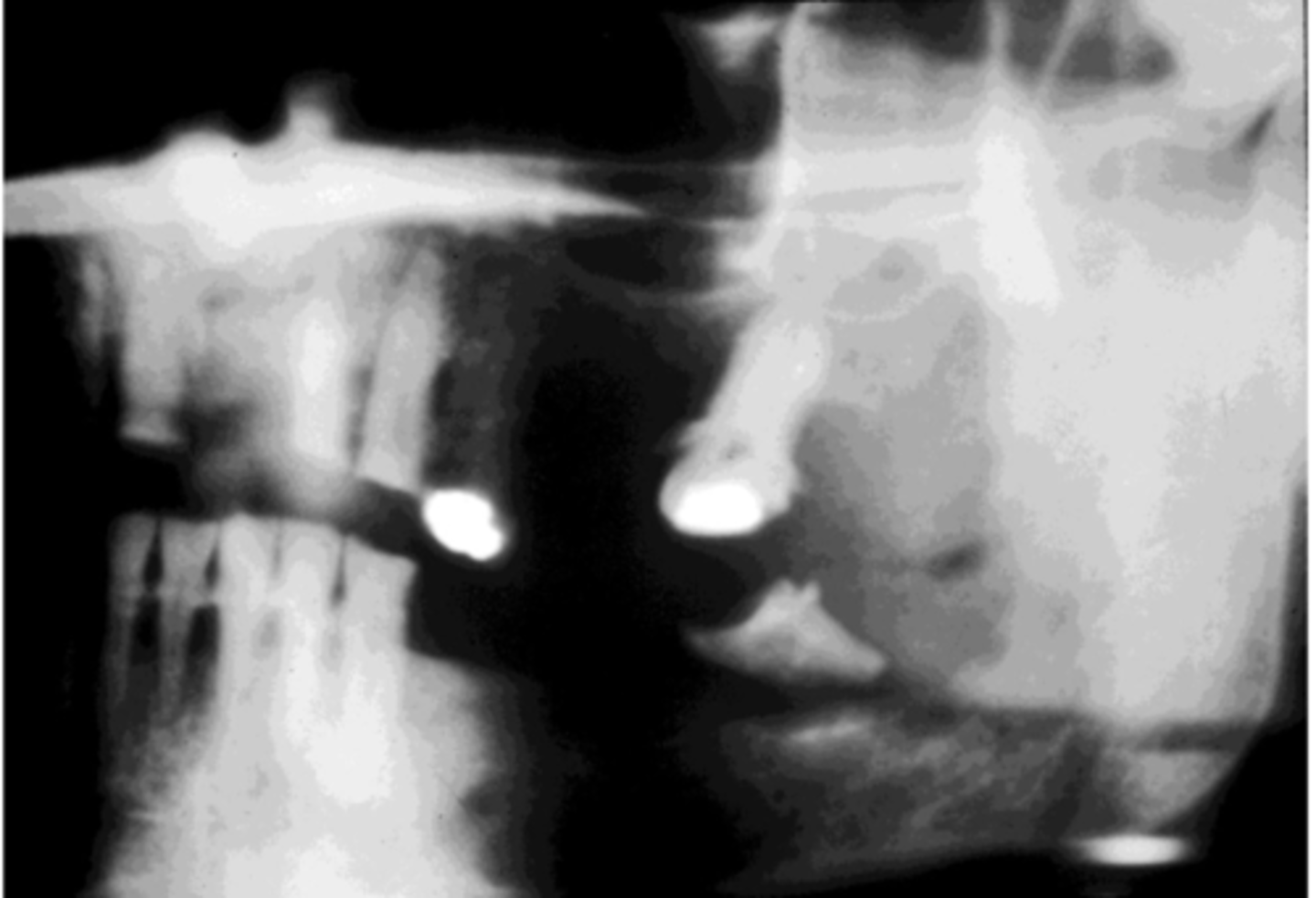 <p>This 77-year-old male presented with a complaint of a loose tooth, swelling of the mandible and tingling of his lower lip. A panoramic radiograph was taken.</p><p>A diagnostic procedure is performed and a diagnosis of adenocarcinoma is rendered. What does that tell you?</p>