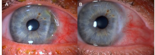 <p>C - presents as guttering near limbus and corneal thinning with possible cells in AC and resolution results in corneal neo and subepithelial fibrosis</p>