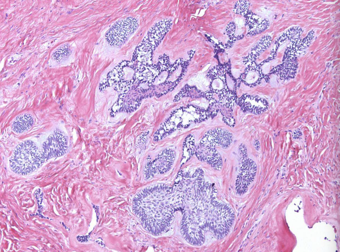 <p>Follicular pattern</p><ul><li><p>Nests of epithelium</p></li><li><p>Island centers resembling stellate reticulum</p></li><li><p>Peripheral columnar cells with nuclei polarized opposite basement membrane (sub-nuclear vacuolization)</p></li><li><p>Mature fibrous background</p></li></ul><p></p><p>Desmoplastic pattern </p><ul><li><p>Compressed islands and cords of odontogenic epithelium in densely collagenized stroma</p></li></ul><p></p>