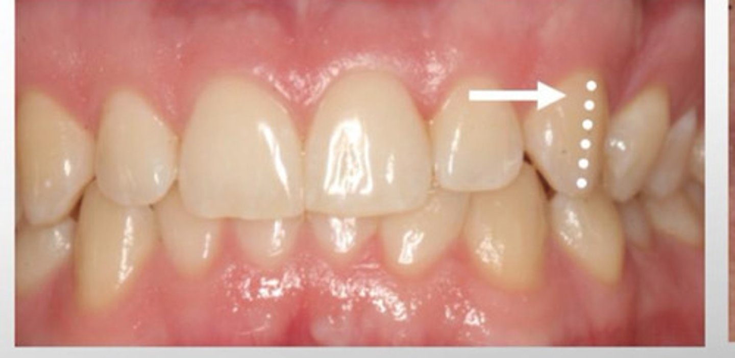<p>A ridge running cervicoincisally in approximately the center of the labial surface of the canines.</p>
