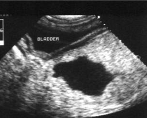 <p>Is this a cyst or abscess?</p>