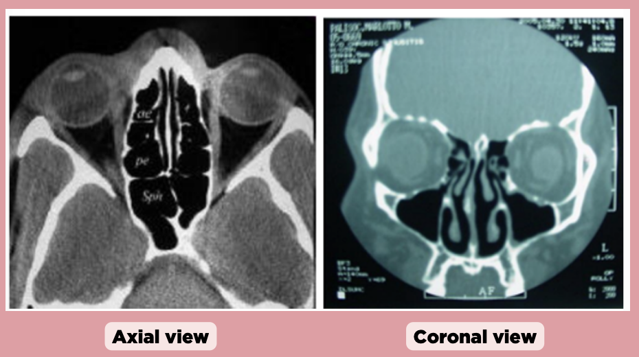 <p>In the coronal view, which sinus is primarily visible and centrally located?</p><p>a. Sphenoid sinus</p><p>b. Frontal sinus</p><p>c. Maxillary sinus</p><p>d. Ethmoid sinus</p>