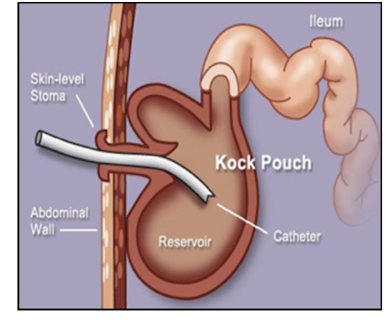 <p>urostomy pouch made from ileal loops, intermittent access to drain pouch as alternative urinary diversion (ilium to abdomen)</p>