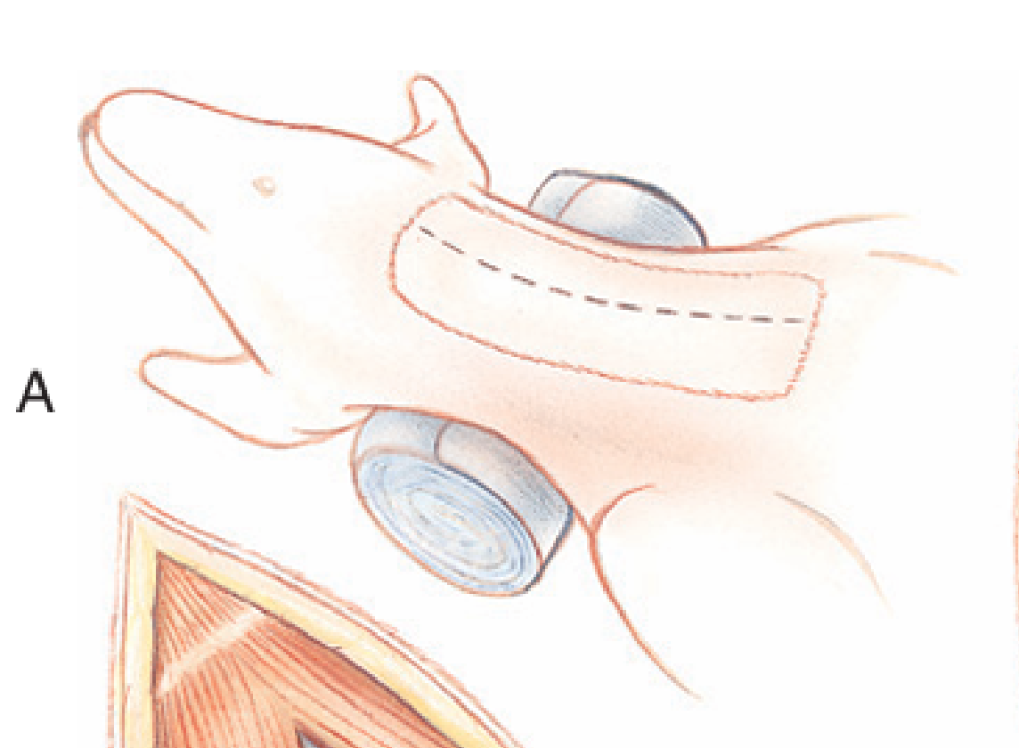 <p>Dorsal recumbency, midline cervical incision beginning at larynx and extending to manubrium.</p>