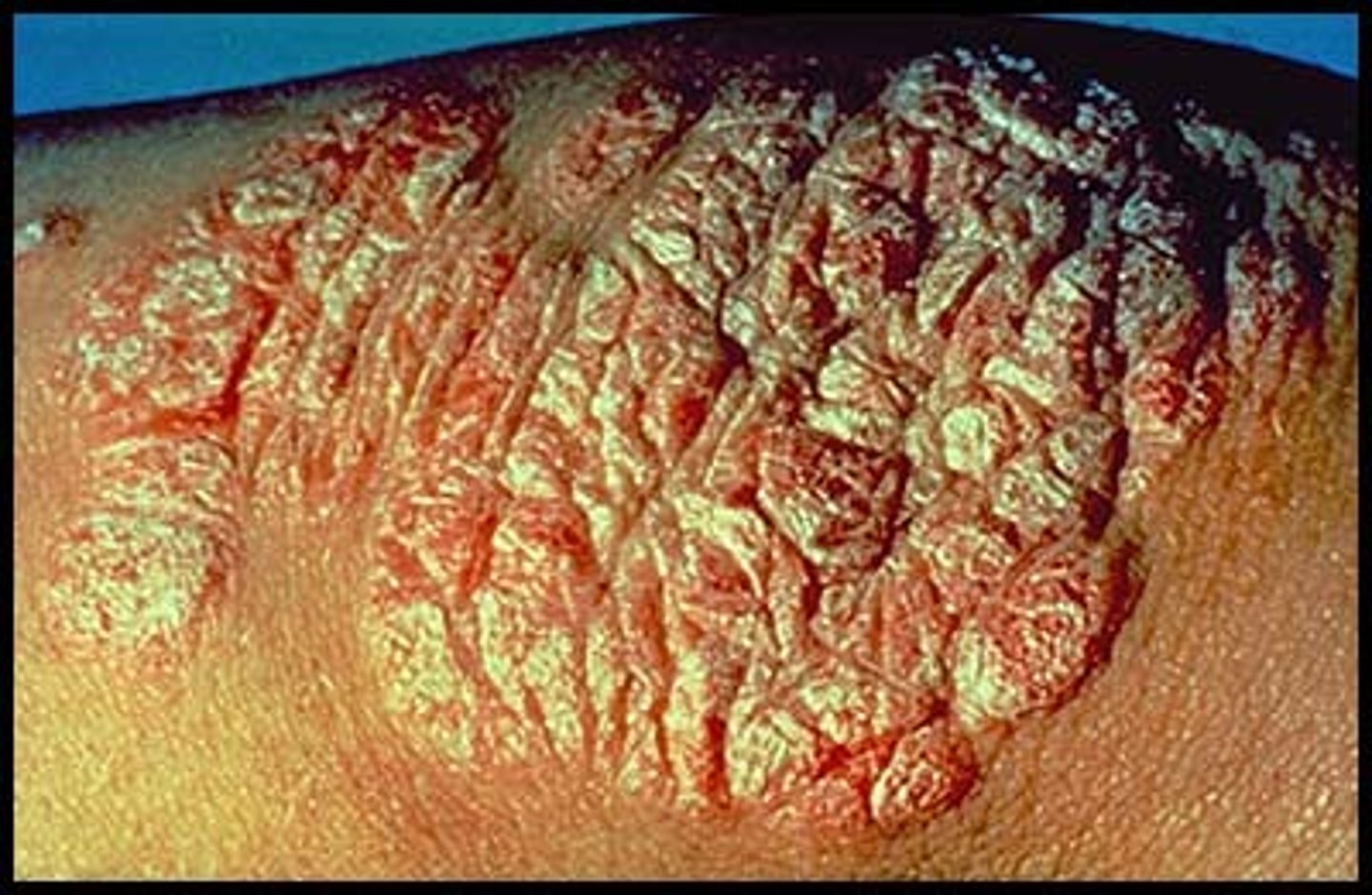 <p>An elevated solid lesion (&gt;1 cm in diameter)</p><p>Examples include psoriasis</p>