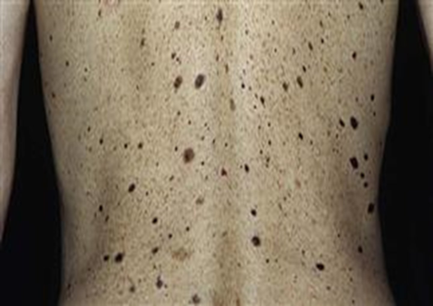 <p>CDKN2A</p><p>Seen in familial atypical mole melanoma syndrome (FAMM)</p>