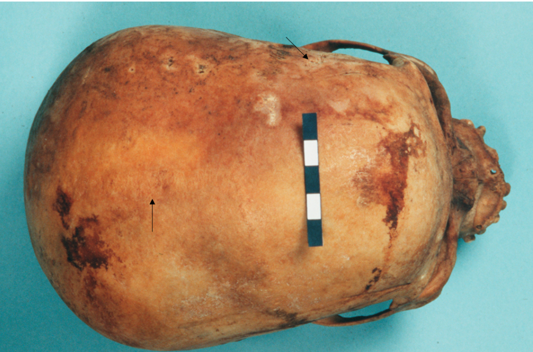 <p><span>What is the score for the coronal and sagittal sutures of this skull?</span></p>