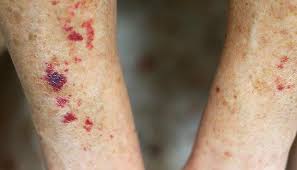<p><span>A bleeding into the skin causing small red areas (PETECHIA) or large red areas (ECCHYMOSIS).</span></p>
