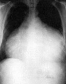 <p>What does this refer to</p><ul><li><p>Findings are variable, depending on etiology and size of effusion</p><ul><li><p>*Not specific and or diagnostic</p></li></ul></li><li><p>&lt; 250 mL may not result in significant findings</p></li><li><p>Larger effusions present with an enlarged cardiac silhouette/clear lung fields</p></li><li><p>**Water bottle–shaped heart<span style="color: red">*</span></p></li></ul><p></p>