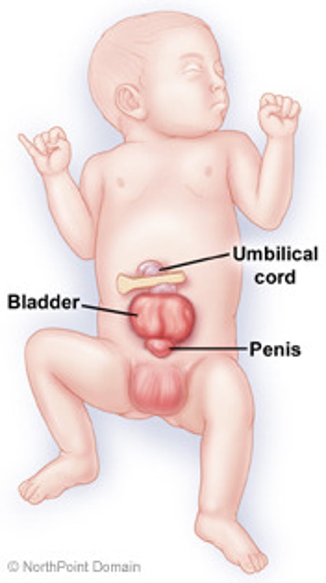 <p>bladder exstrophy</p>