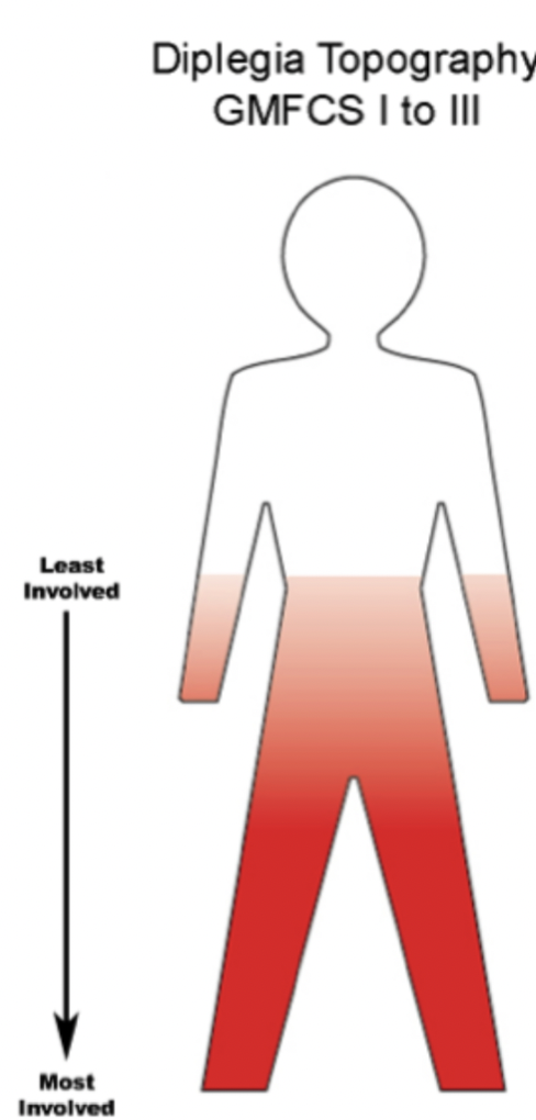 <p>cerebral palsy, causes muscle stiffness in both legs (hypertonia)</p>