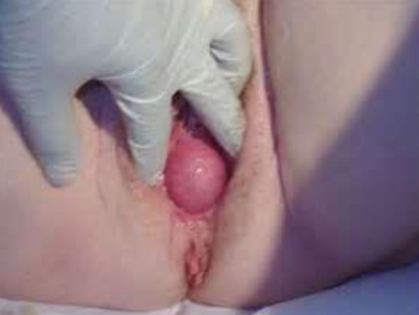 <p>anterior vaginal wall prolapse</p>