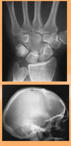 <p>-Carpal and tarsal bones</p><p>-Calvarium, sternum, ribs, and scapulae </p>