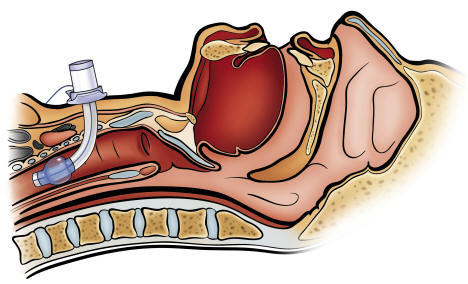 <p>Surgically, by creating an opening into the trachea.</p>