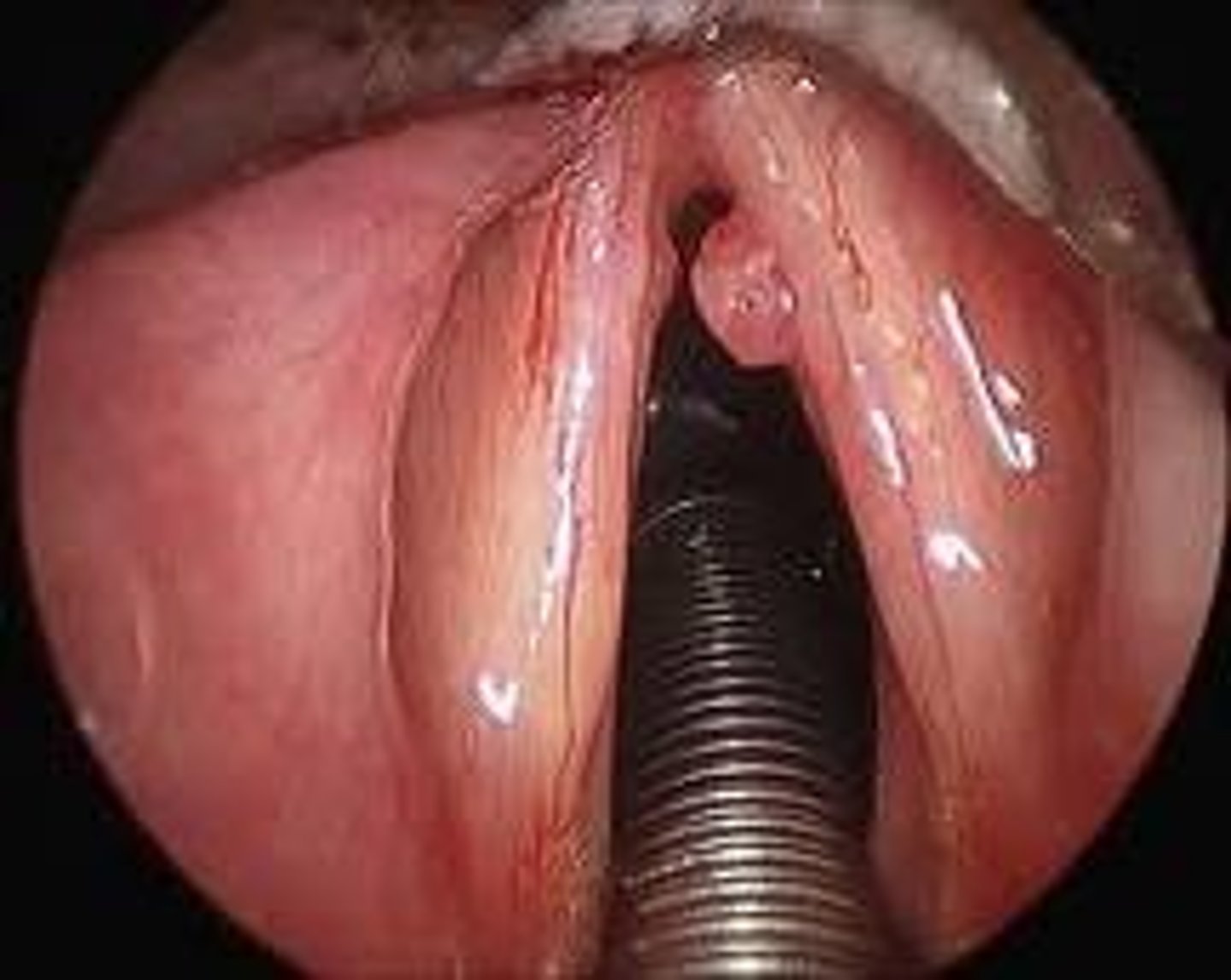 <p>small swellings in the mucous membranes of the vocal cords that develop from voice abuse, chronic allergic rxns in the larynx, &amp; chronic inhalation of irritants (ex: industrial fumes &amp; cigarette smoke) </p><p></p><p>*<strong>usually unilateral</strong></p>