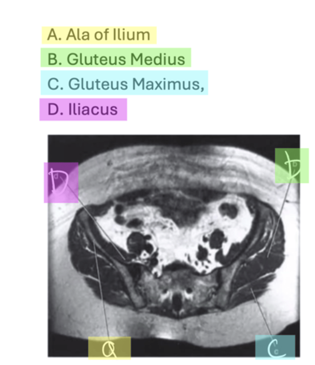 <p>A. Ala of Ilium</p><p>B. Gluteus Medius C. Gluteus Maximus</p><p>D. Iliacus</p>