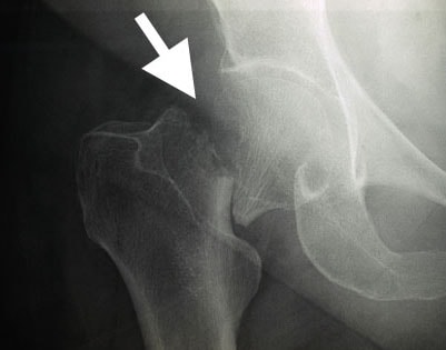 <p>What kind of fracture is this?</p>