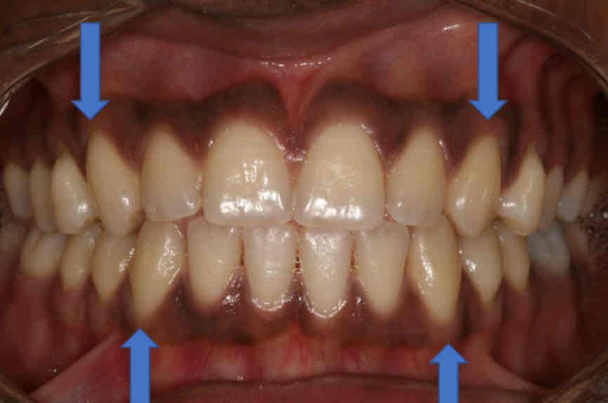 <p>in the FDI system, what teeth number is the maxillary and mandibular canines?</p>