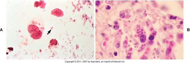 penetrate intestinal cell, tachyzoite formation, rupture the cells. Can form cysts in tissues of immunocompromised individuals. Can pass onto the fetus