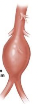 <p>What aneurysm is this</p>