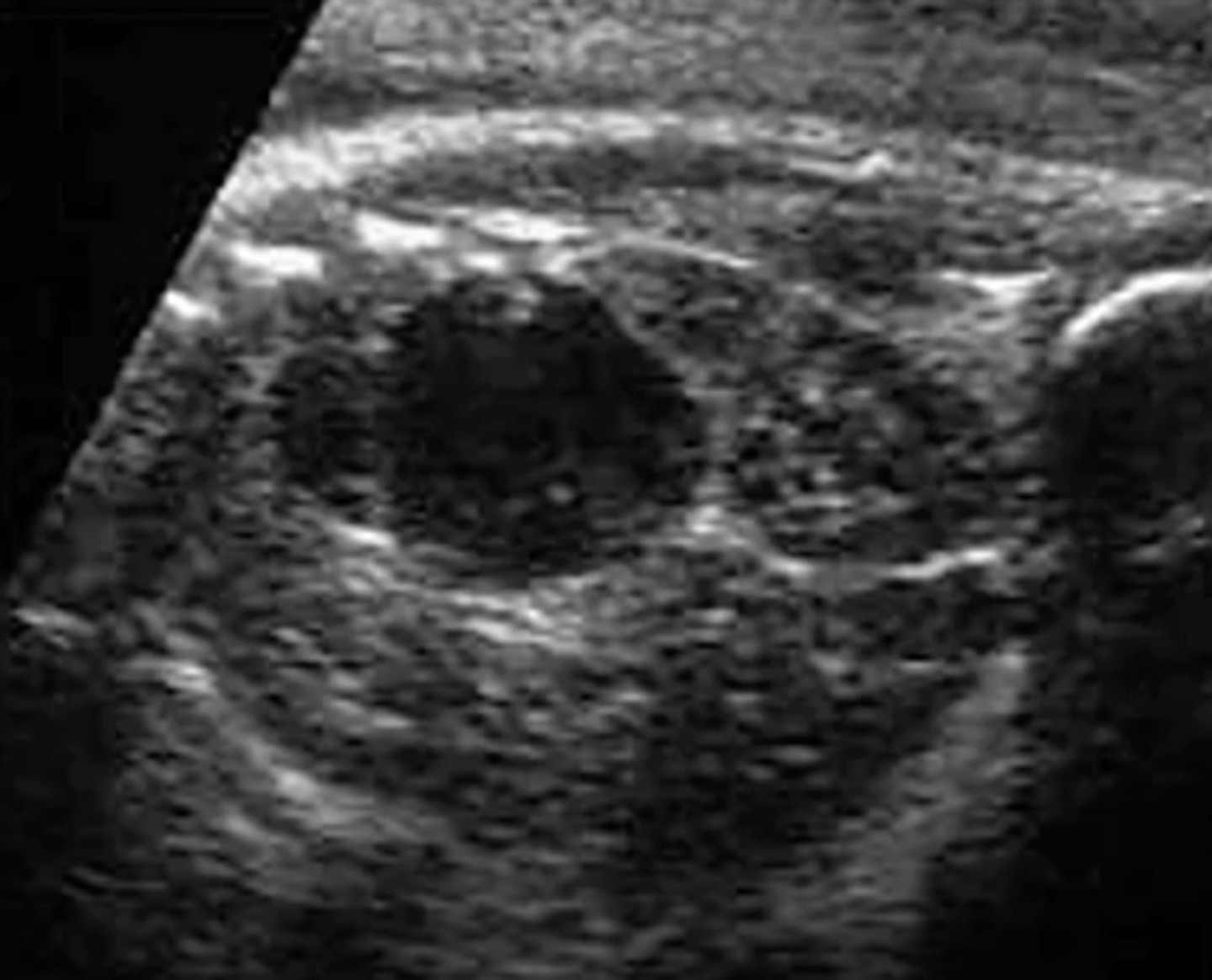 <p>What is the typical sonographic appearance of a neuroblastoma?</p>
