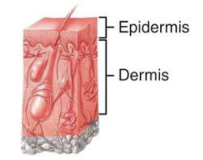 <p>Destroys the epidermis and part of the dermis; Ex/ blister</p>