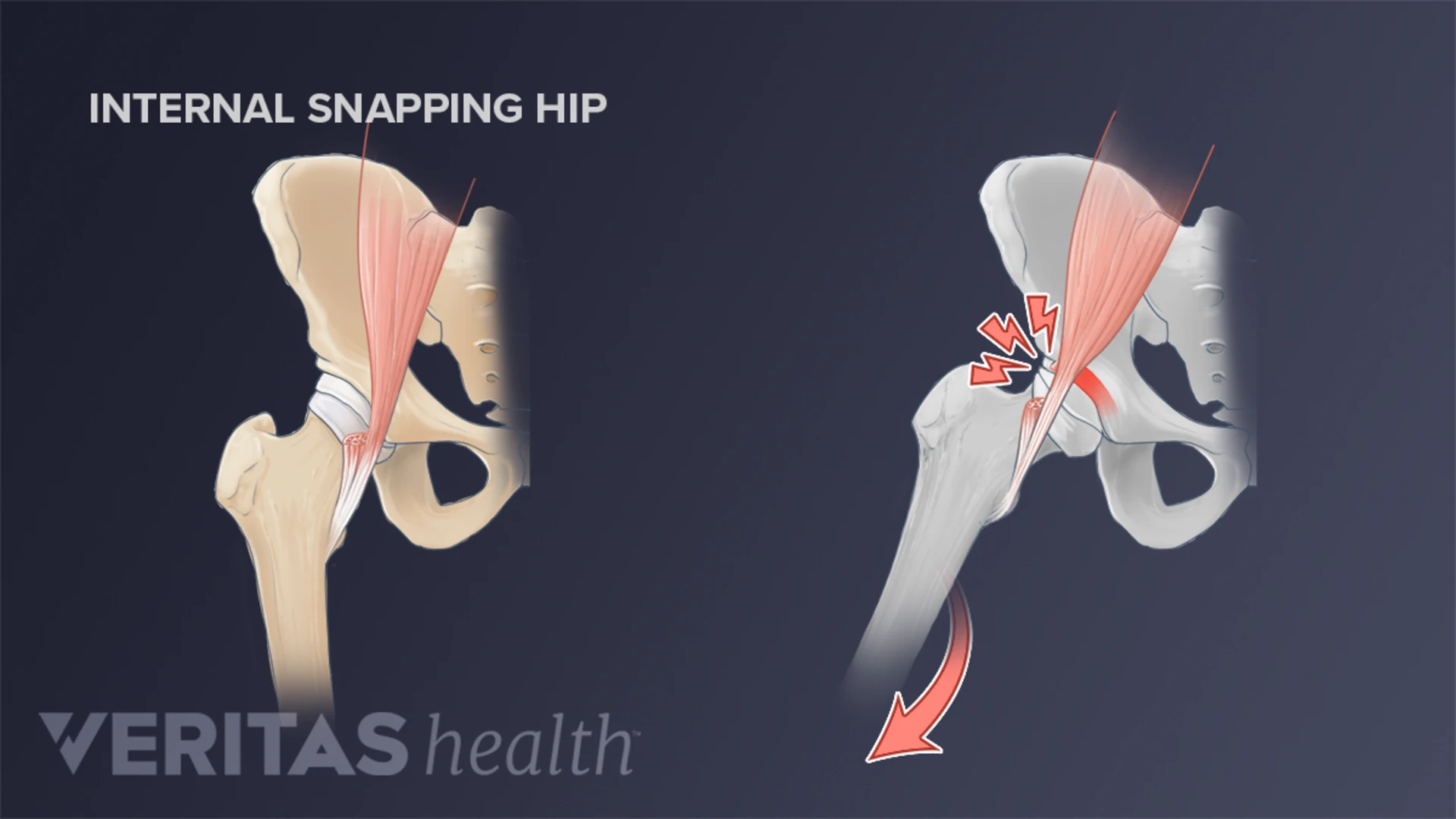 <p>Where the iliposoas tendon snaps over the femoral head or anterior pelvis, causing a snapping sensation</p>