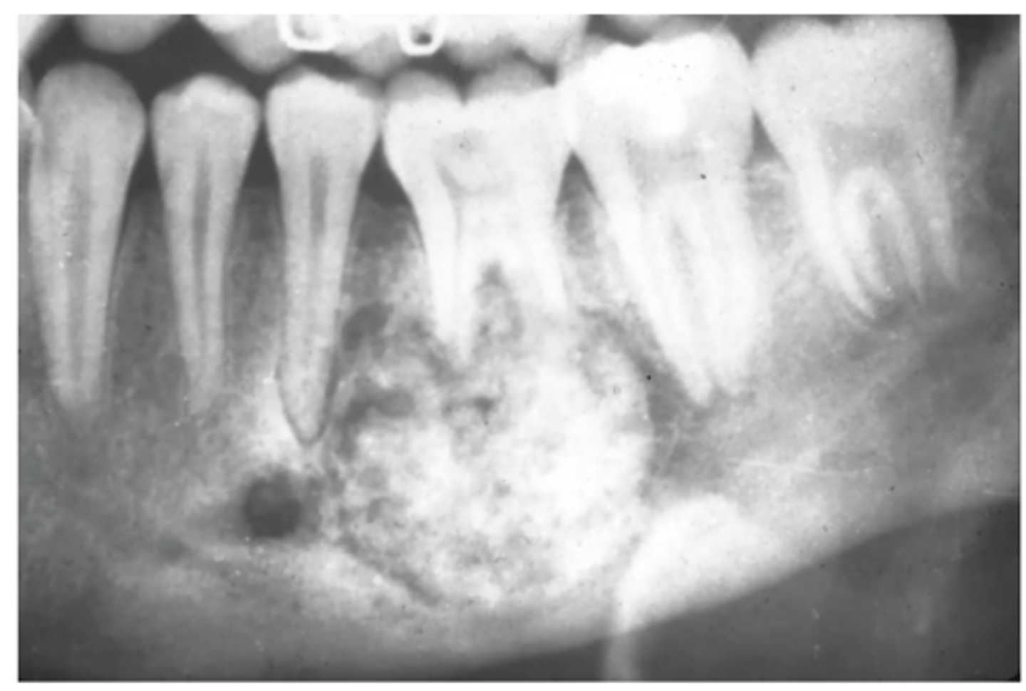 <p>External resorption of root</p>