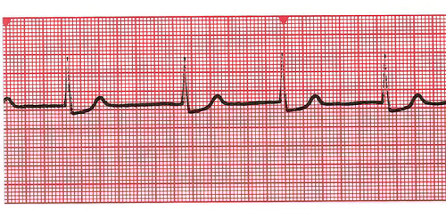 <p>Irritable foci speeds up to override the SA node for control (possible SA node failure)</p><p>P wave is lost completely</p><p>goes directly into QRS complex</p><p>atrial rate = ventricular rate</p><p>RATE = 40-60 bpm</p>