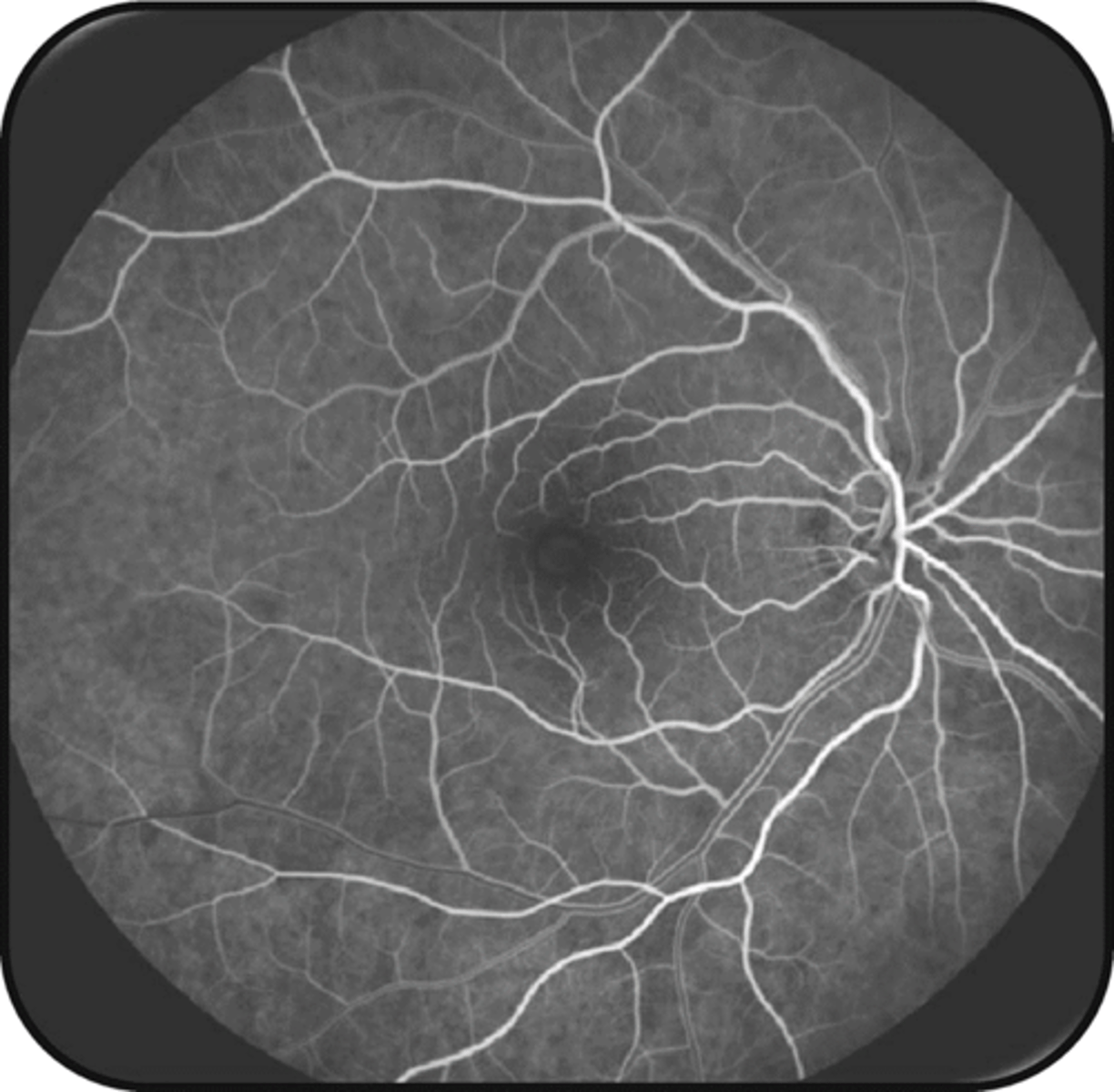 <p>plasma w/ NaFl is rapidly moving along walls bc central lumen has more RBC = vein walls appear hyperF but center lumen appears hypoF (esp noticeable in large caliber veins)</p>