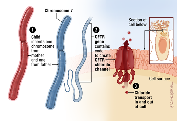 <p><span>•Mutations in <strong>CFTR (cystic fibrosis transmembrane conductance regulator) gene</strong></span></p><p><span>•CFTR normally in membranes of cells to produce mucus, sweat, saliva, digestive enzymes</span></p><p><span>•Mutated? <strong>Impaired transport of Cl- &amp; H2O in and out of cells; cells in lungs produce mucus that is abnormally thick</strong></span></p><p><span>Individuals w/ cystic fibrosis have very salty sweat due to lack of reabsorption of Cl- back into cells, leading to higher Cl- in sweat and salty sweat</span></p><p style="text-align: left;"><span>Impaired movement of water to outside of lung cells – sticky, thick mucus and lack of clearance of bacteria from respiratory tract</span></p><p style="text-align: left;">This image breaks down the normal function of the <strong>CFTR gene</strong>, from its genetic origin to its role as a crucial channel in our cells.</p><div data-type="horizontalRule"><hr></div><p></p><p>From Gene to Function</p><p></p><p>The diagram illustrates a three-step process:</p><ol><li><p><strong>Inheritance:</strong> A child inherits two copies of <strong>Chromosome 7</strong>, one from each parent. This chromosome contains the genetic blueprint for many proteins, including CFTR.</p></li><li><p><strong>Protein Production:</strong> A specific section of Chromosome 7, the <strong>CFTR gene</strong>, holds the instructions to create the CFTR protein. This protein folds into a channel that is placed on the cell's surface.</p><p></p></li><li><p><strong>Chloride Transport:</strong> The normal function of this channel is to transport chloride ions (and by extension, water) in and out of the cell. This is vital for maintaining the right balance of salt and water in secretions like mucus, sweat, and digestive enzymes.</p></li></ol><p></p>