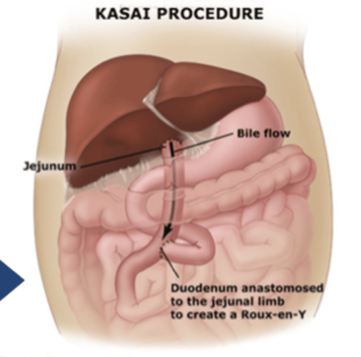 <p>failure to form or early destruction of extrahepatic biliary tree</p><p>- tx: kasai procedure (w/i 6 wks)</p>