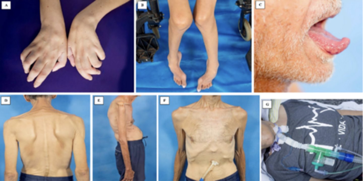 <p>atrophy, flaccidity, fasciculations, and decreased reflexes</p>