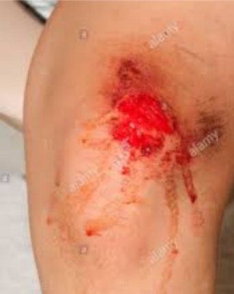 <p>VULNUS CONTUSUM</p><ul><li><p>caused by <strong>blunt trauma</strong>, such as a <strong>fall</strong>, <strong>blow</strong>, or <strong>impact</strong> with a hard object.</p></li><li><p>occurs where bone is directly under the skin</p></li><li><p>e.g scalp, elbow, shin ect </p></li><li><p>Skin and soft tissue are compressed between two hard surfaces (e.g., bone and blunt object like a bat).</p></li></ul><p></p><ul><li><p>skin <strong>splits open due to pressure</strong>, not slicing</p><p class=""></p><p class="">associated with:</p><ul><li><p class="">Bruising (Contusion)</p></li><li><p class="">Swelling (hematoma)</p></li><li><p class="">Crushing of underlying tissues</p></li></ul></li></ul><p class=""></p><p class="">Contusion (Bruise) Color Progression:</p><ol><li><p>blue/ purple- du to deO2 blood</p></li><li><p>green - Hemoglobin —&gt; biliverdin </p></li><li><p>yellow- biliverdin —&gt; bilirubin </p></li></ol><p></p><p></p><p><strong>Morphological Features</strong></p><ul><li><p>Irregular wound edges</p></li><li><p><strong>raised, livid (bluish-purple)</strong> borders</p></li><li><p>Minimal change in anatomy</p></li><li><p><strong>Soft tissue</strong> injury, bordered by <strong>bone</strong></p><p></p></li></ul><p><strong>Stupor Reticaris</strong>- around wound, lump in middle, hematoma around it,</p><p>infection inside.</p><p><strong>Stupor Localis- </strong>swelling with inflammation, <strong>livid edges</strong>, maybe some necrosis</p><p>Deep contusion and hematomas </p><ul><li><p>DANGEROUS coz can cause Tetnus/ infections</p></li></ul><p></p><p>Management </p><ul><li><p class=""><strong>Observation</strong> and monitoring for swelling or infection</p></li><li><p class=""><strong>Cleaning</strong> wound to prevent infection</p></li><li><p class=""><strong>Excision and drainage</strong> if the hematoma is deep or infected</p></li><li><p class=""><strong>Tetanus</strong> vaccine if needed</p></li></ul><p></p><p></p>