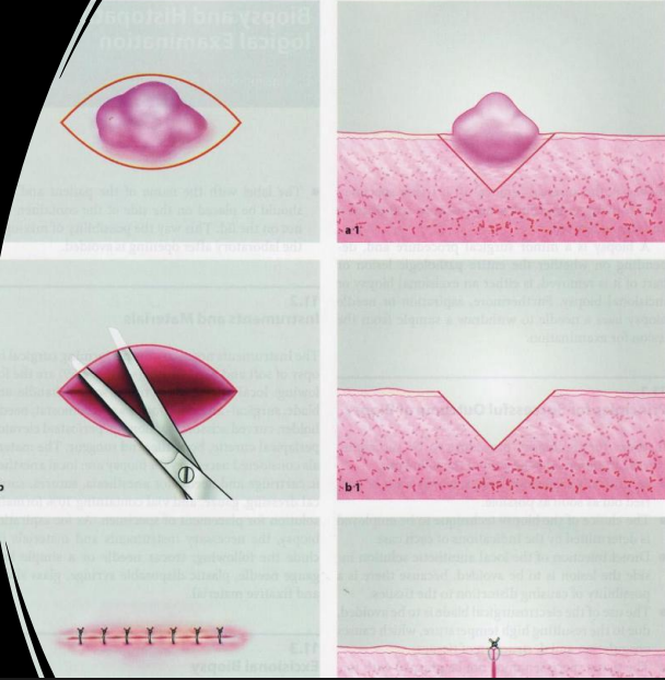 <p>complete surgical removal; small lesions &lt;2 cm; appears benign on clinical </p>