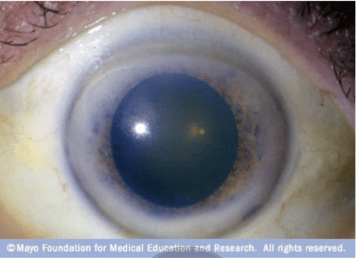 <p>Gray ring around eye</p>