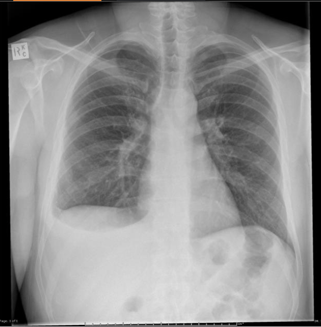 <p>Patient presents to the ER for CP that is exacerbated by breathing. He also reports a cough and dyspnea. On a physical exam you note dullness to percussion and diminished breath sounds over the left lower lung. When you ask the patient to say, E it sounds more like A. CXR shows fluid in dependent lung zones, costophrenic blunting. How can we tell the difference between transudative and exudative</p>