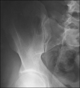 <p>Closes the superior joint space.</p>