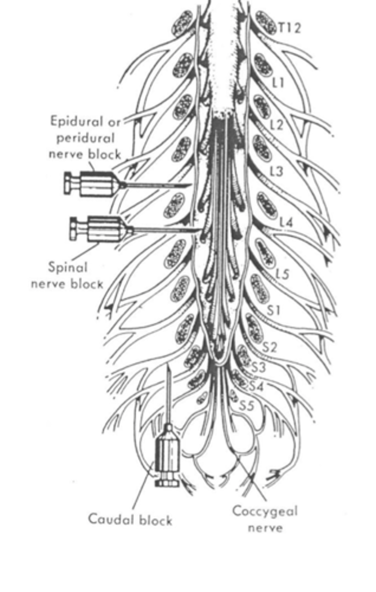 <p>Administration into subarachnoid space</p>
