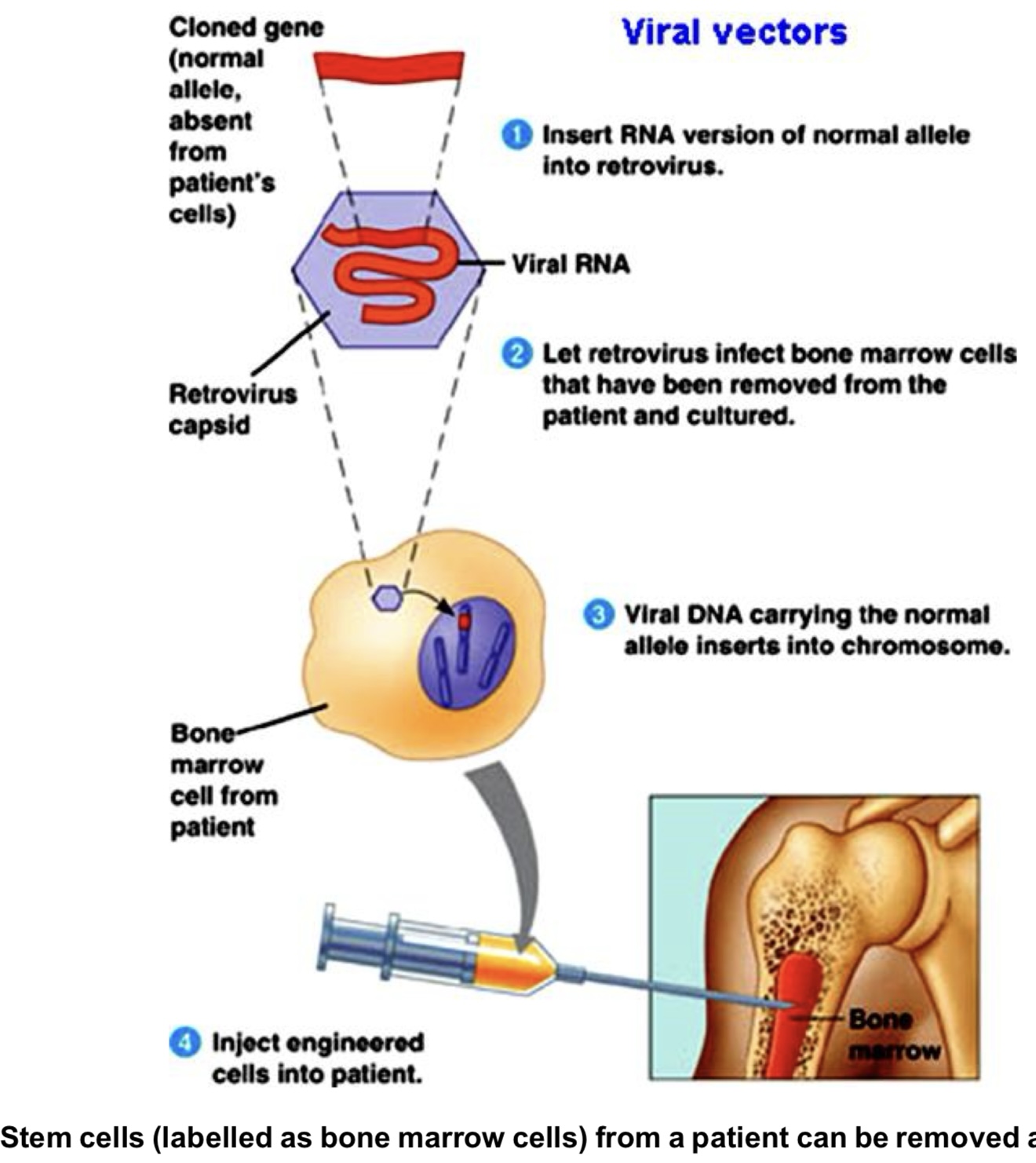 <p>advantages</p><ul><li><p>no immune rejection → stem cells are the patient’s own</p></li><li><p>less ethical issues than usage of embryonic stem cells</p></li><li><p>no need for repeated treatment → adult stem cells capable of self-renewal, maintaining constant pool</p></li></ul><p>disadvantages</p><ul><li><p>adult stem cells are found in small numbers, difficult to isolate and culture</p></li><li><p>adult stem cells produce a limited number of cell types (multipotent) → cannot be used to treat all diseases</p></li><li><p>risks involved in retroviruses</p><ul><li><p>retroviral insertional mutagenesis → retrovirus integration into the genome can transform cells by oncogene activation or tumour suppressor gene inactivation → can trigger onset of cancer</p></li></ul></li></ul>