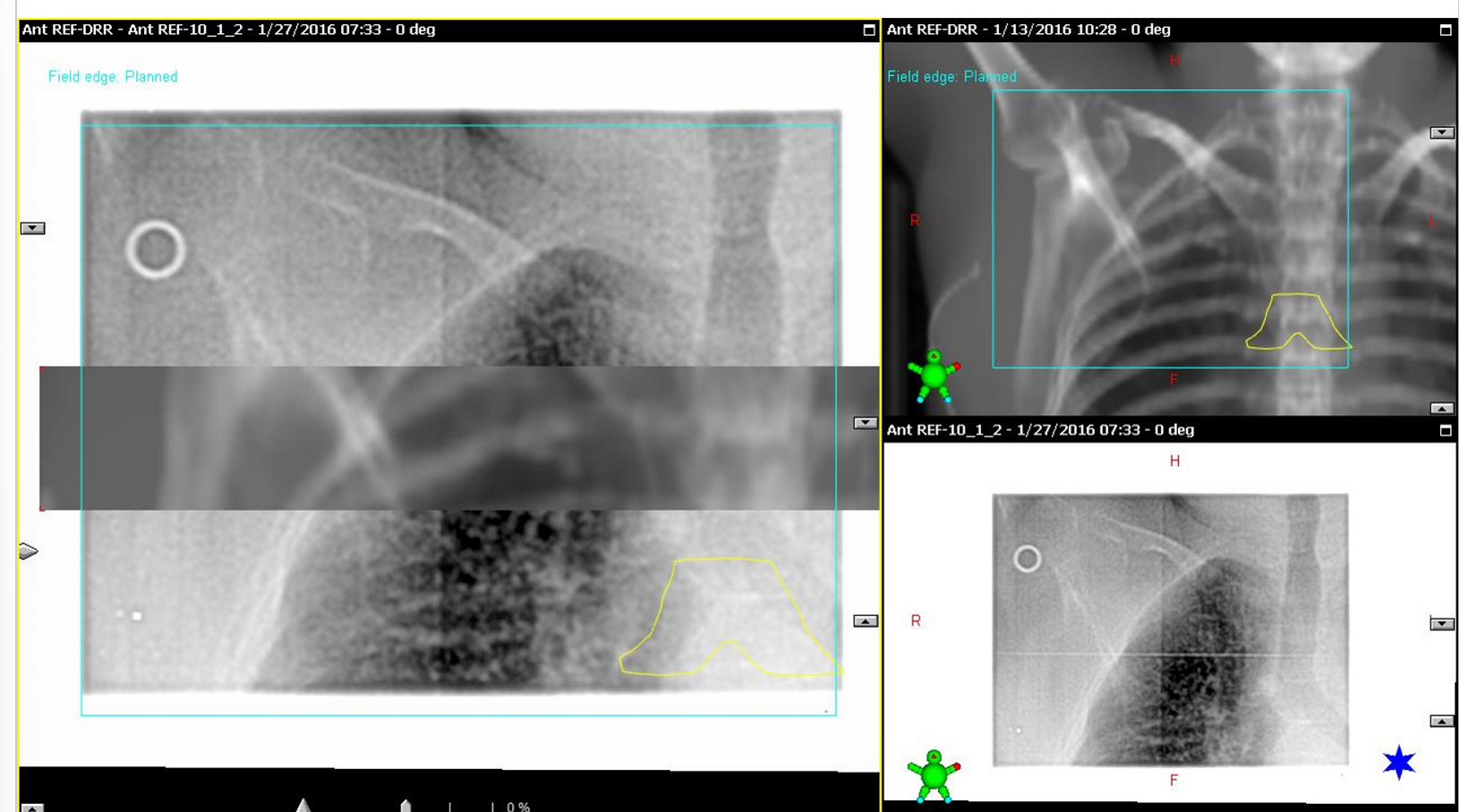 <p>because the carina is not well visualized without it</p>