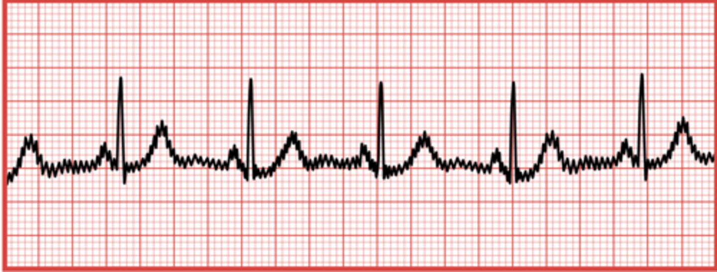 <p>uniform spikes on an EKG caused by electrical interference.</p>